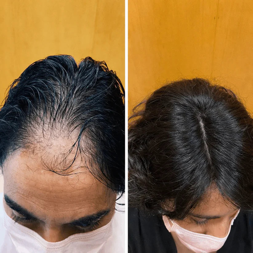 Luneria - Detiene la Caída del Pelo y Estimula el Crecimiento de Raíz