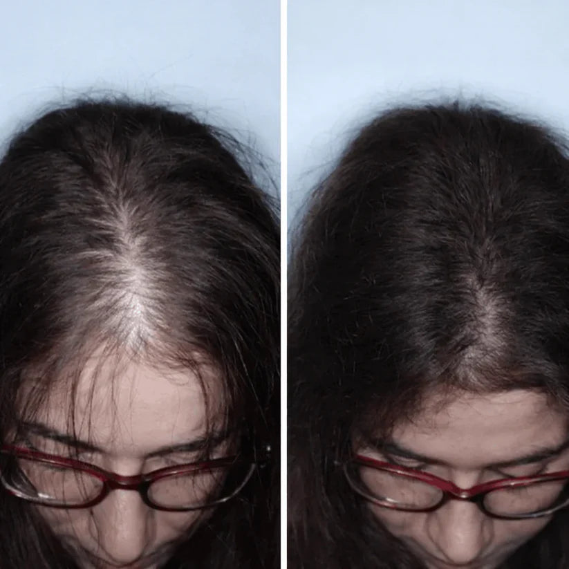 Luneria - Detiene la Caída del Pelo y Estimula el Crecimiento de Raíz