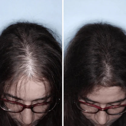 Luneria - Detiene la Caída del Pelo y Estimula el Crecimiento de Raíz